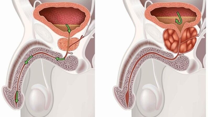 Stagnation des Urins über Prostatitis