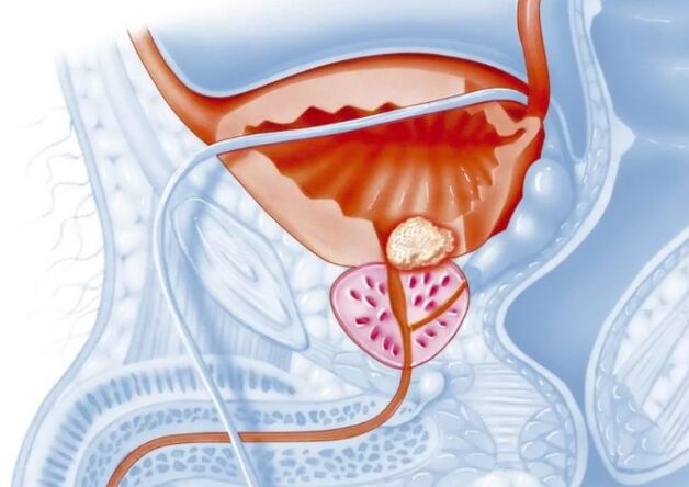 Merkmale einer chronischen Prostatitis